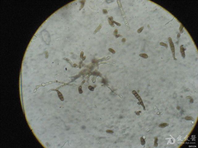 这是什么皮肤病间擦疹伴真菌感染