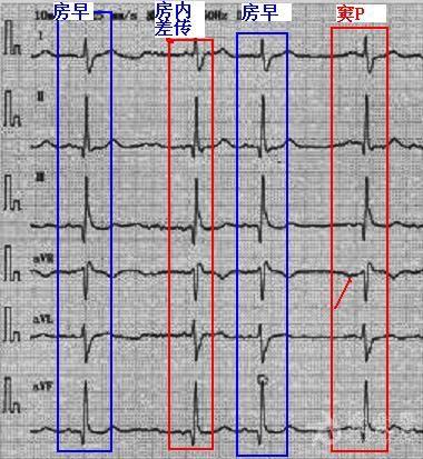 竇房傳導阻滯麼急傳了12導聯圖