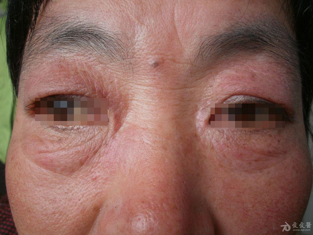 脸部皮肌炎的症状图片图片