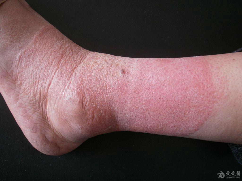 接触性皮炎红斑图片图片