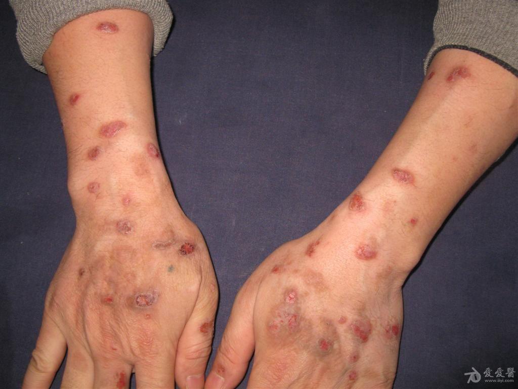痒疹是什么症状图片