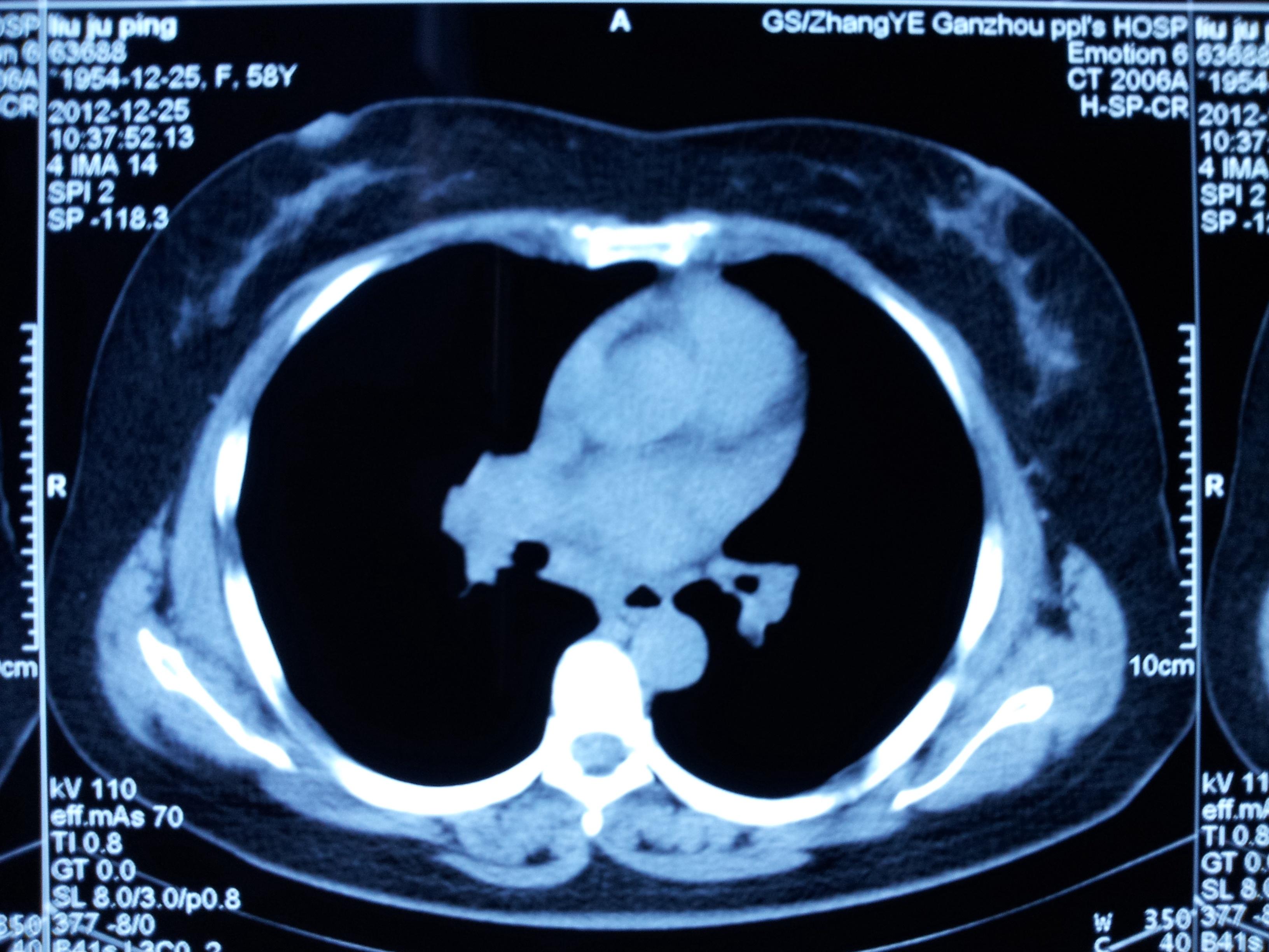 肺门肿瘤图片图片