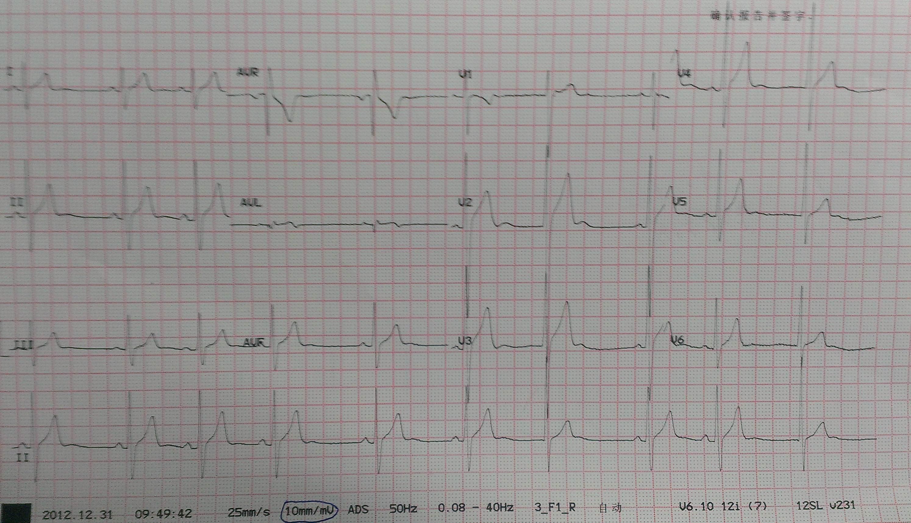 心电图电压高图片