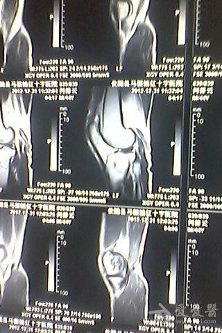 请大家看一下这个病骨梗死急