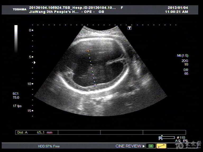 胎儿脑积水一例