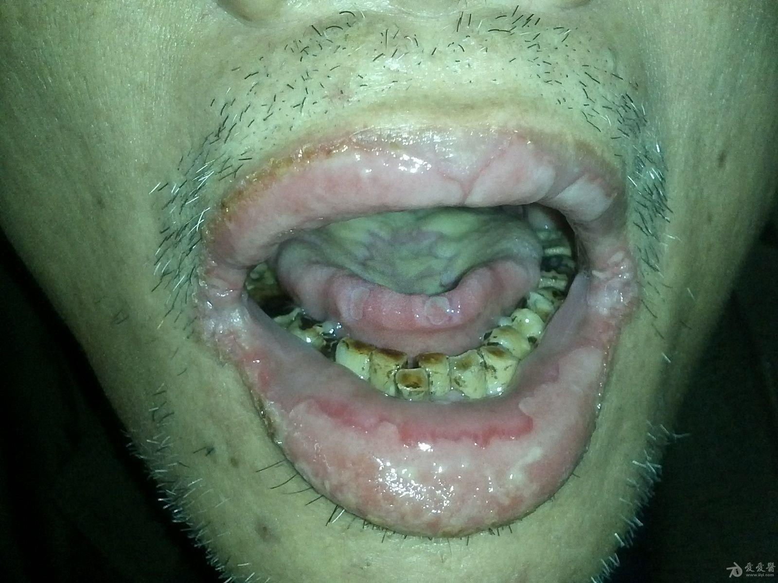 口腔增生性红斑图片图片