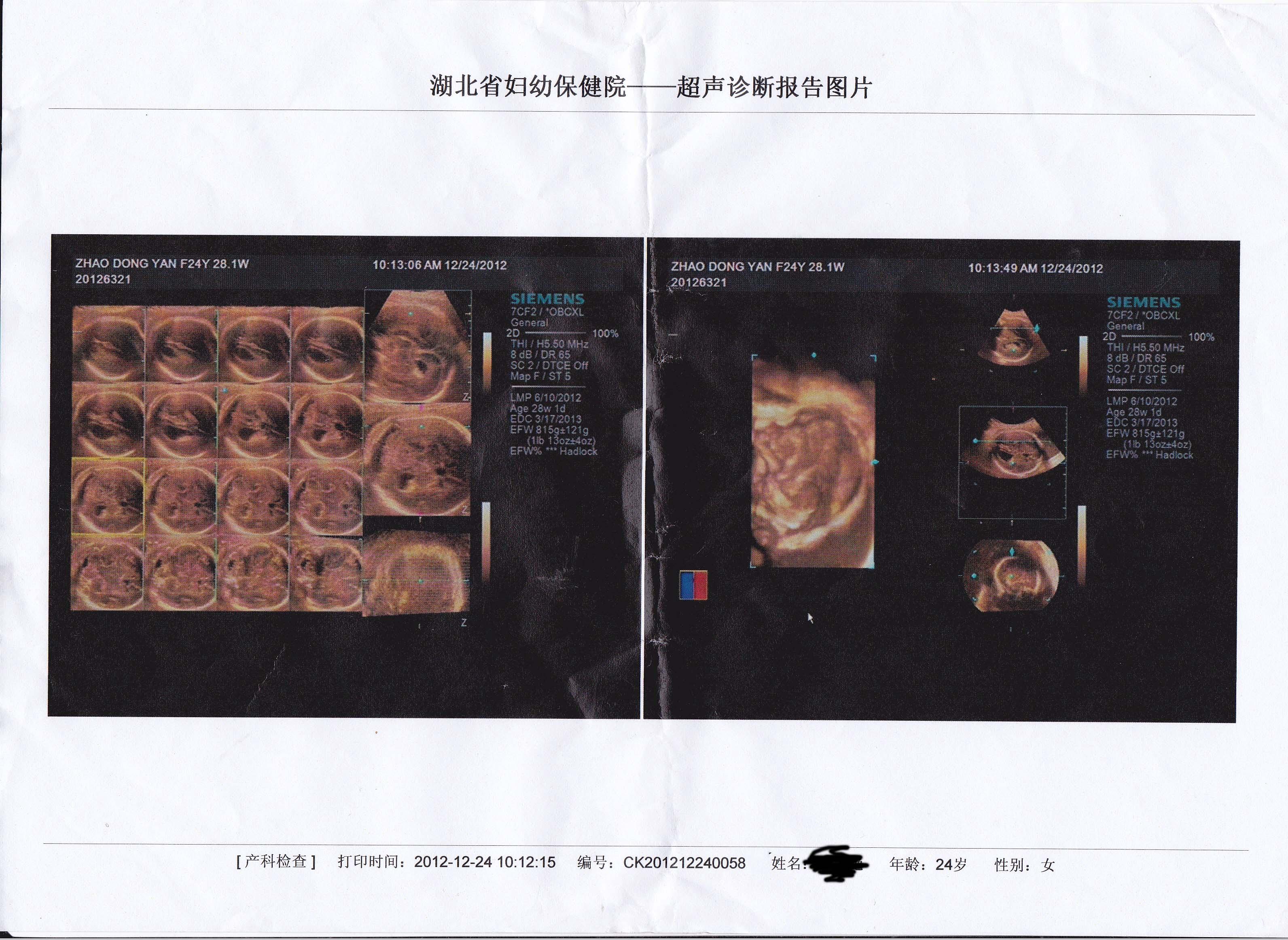 胎儿侧脑室增宽图片