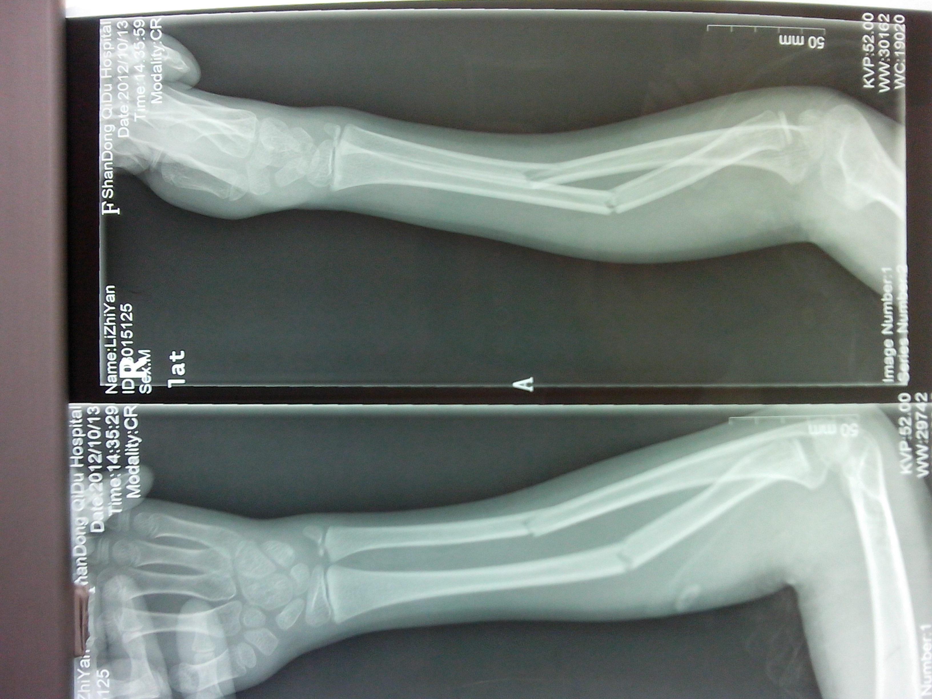 我院骨二科完成首例弹性髓内钉治疗儿童右前臂双骨折！_手术