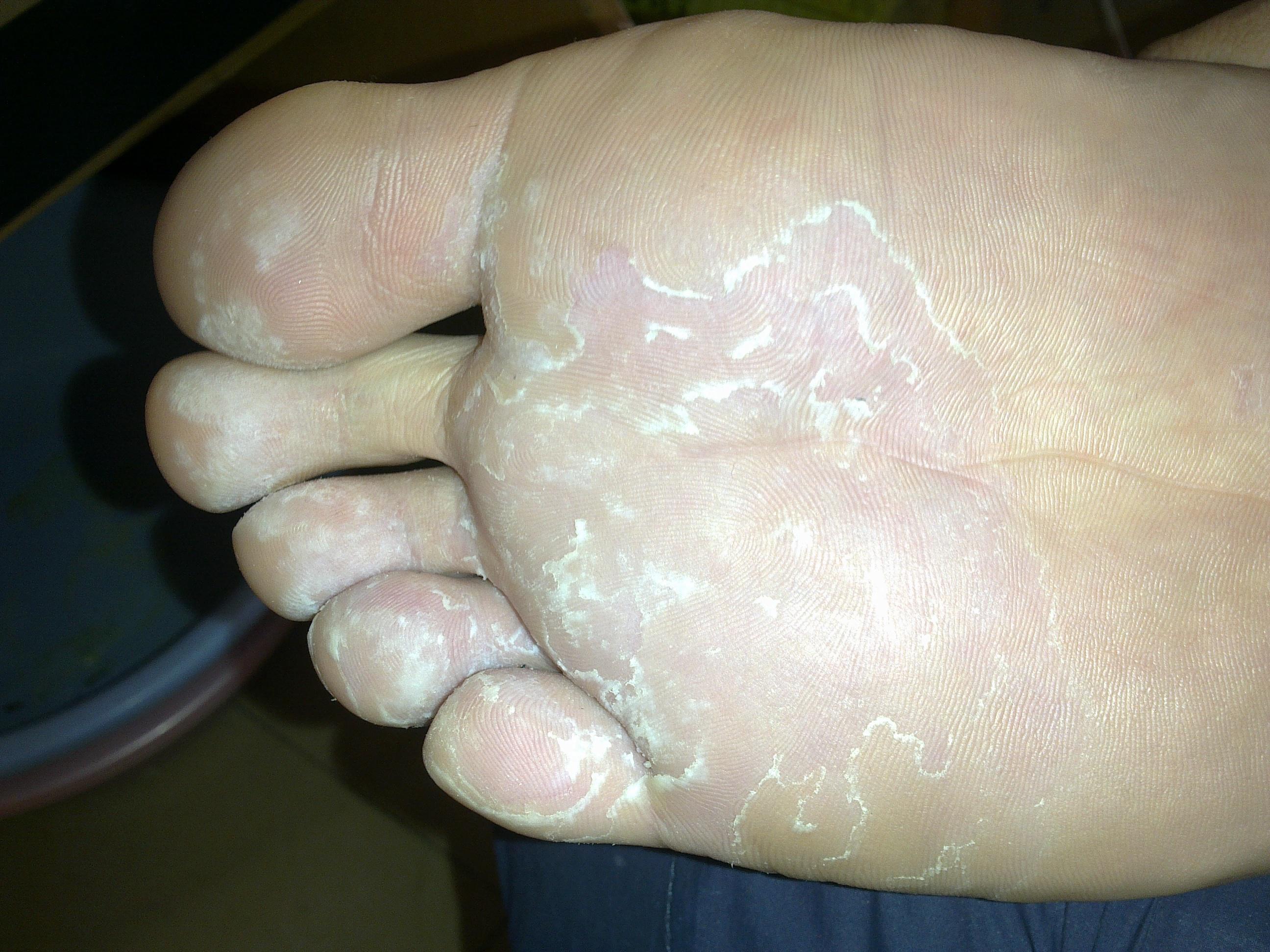 脚上最近变这样子了怎么回事这是刚洗完脚的图片有懂得过来看看啊