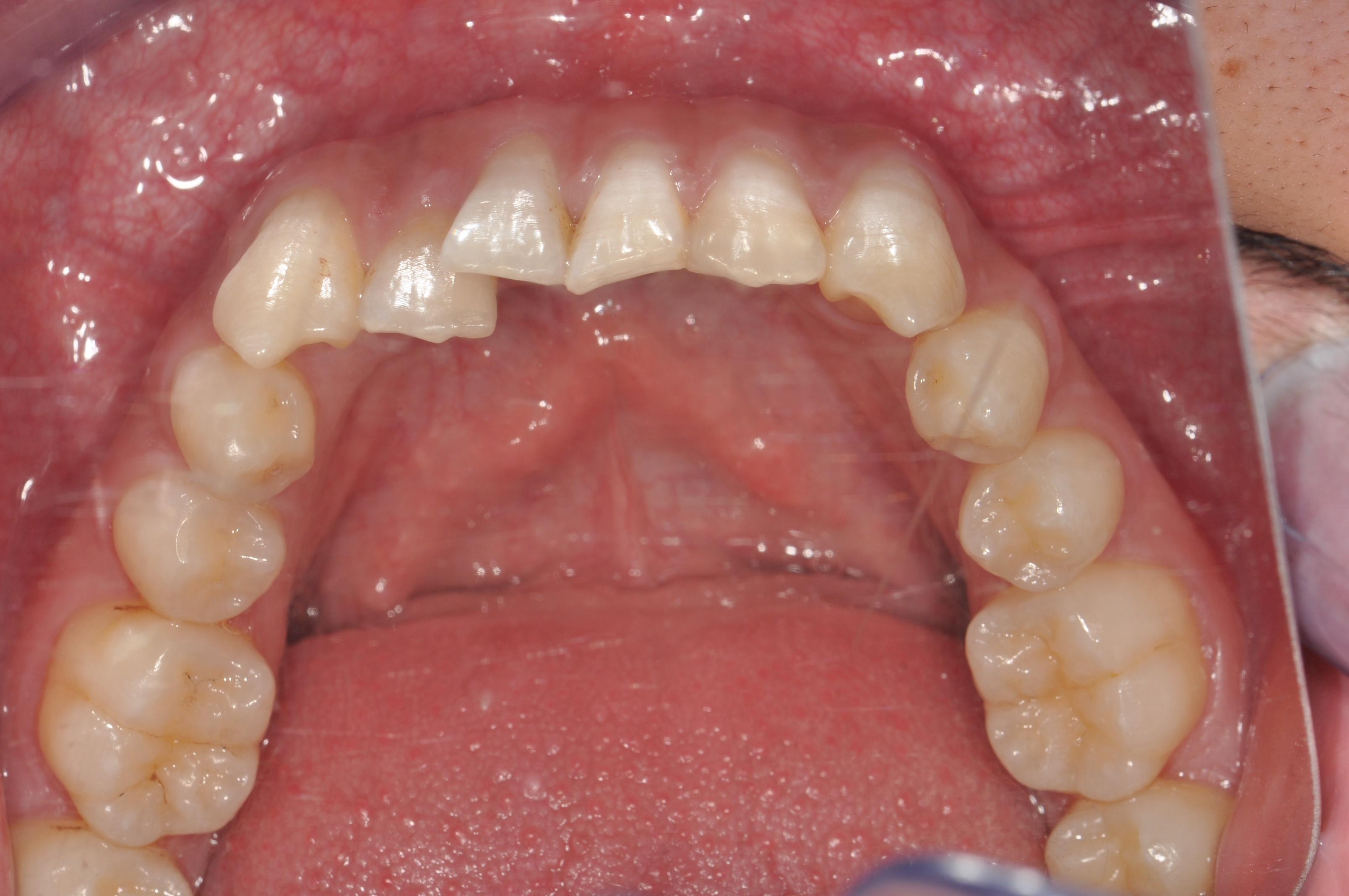 上颌尖牙与第一前磨牙异位伴前牙反颌