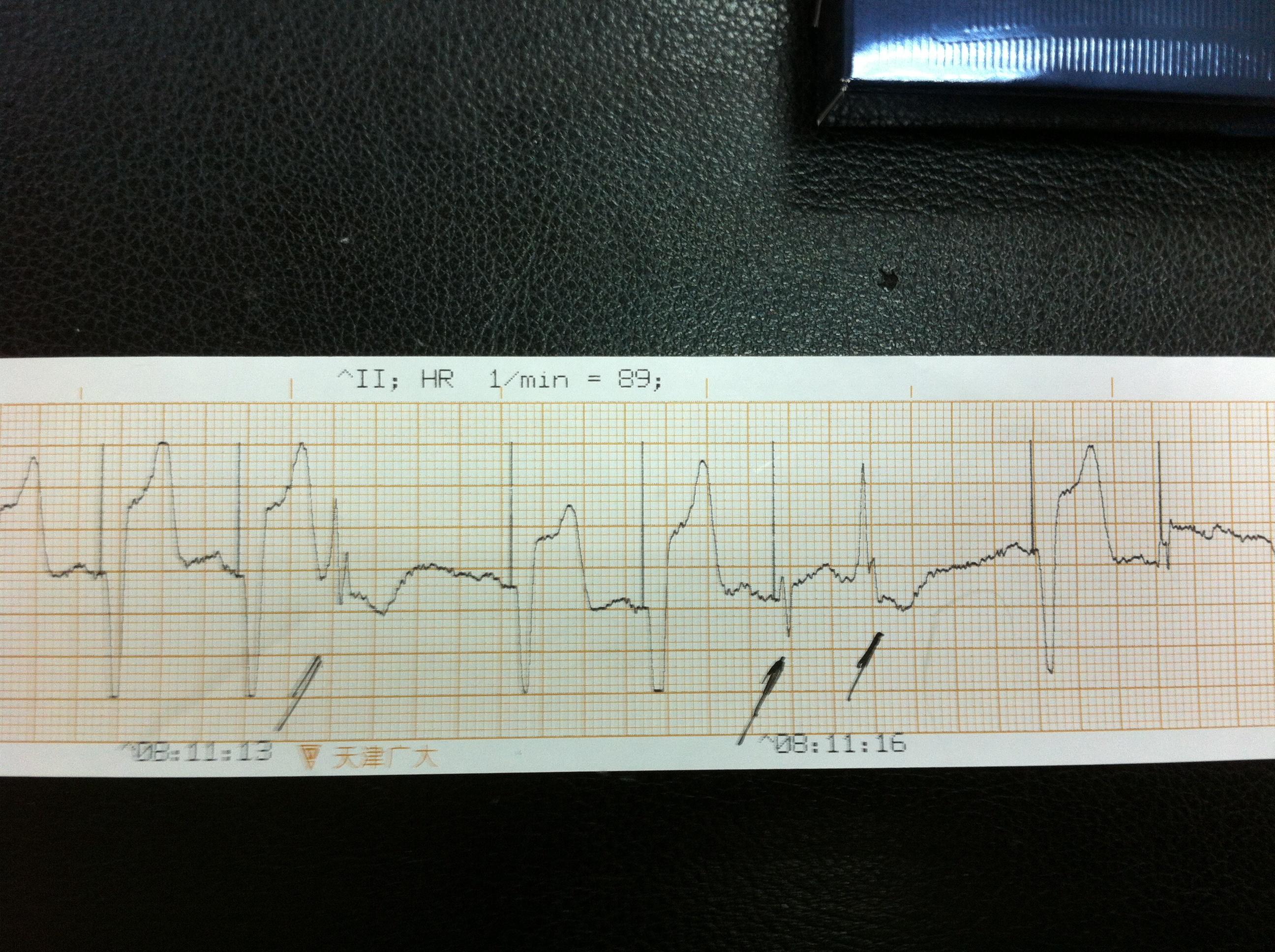 心脏起搏器心电图特点图片