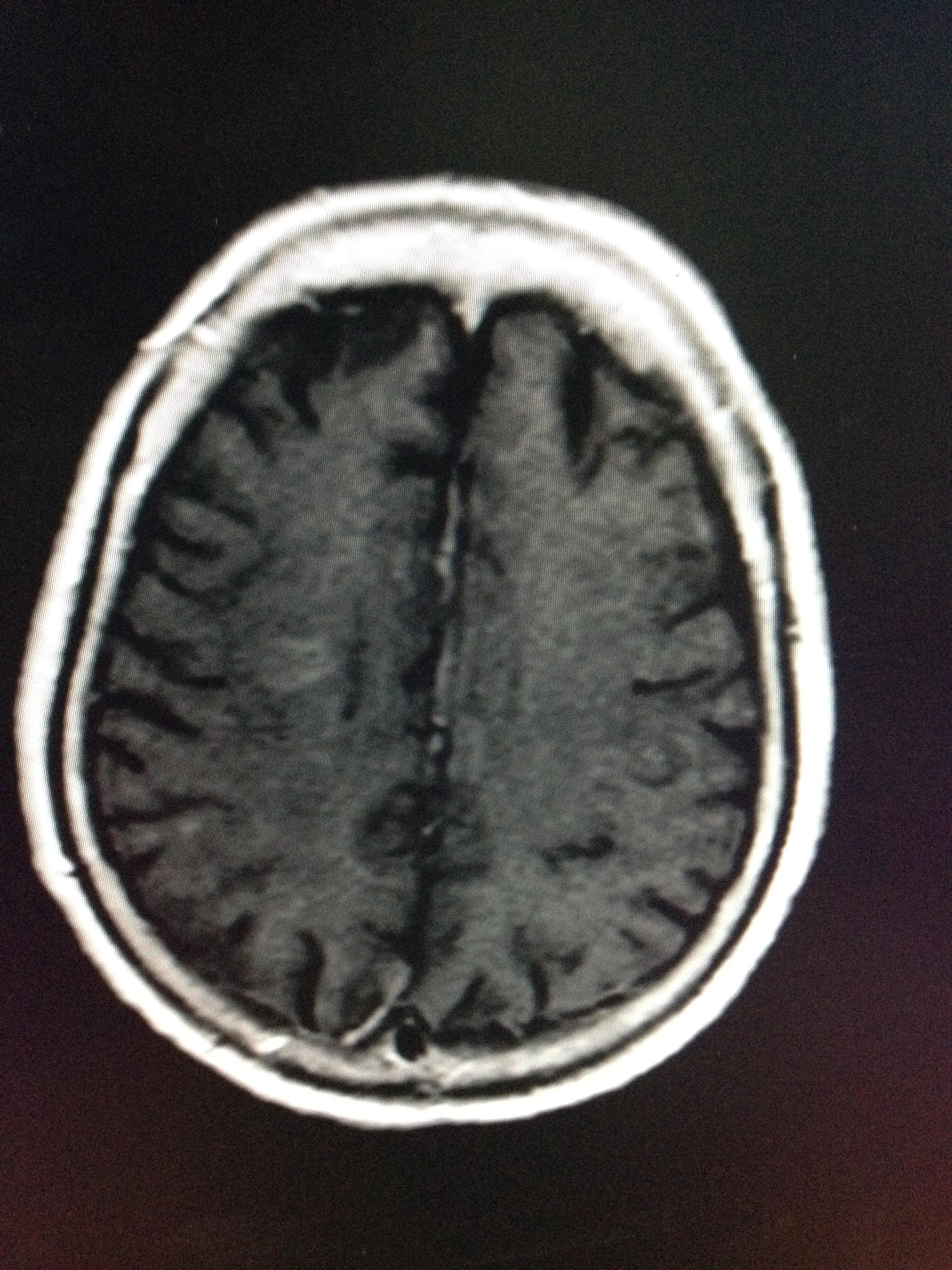 大家来看看是什么病?mri