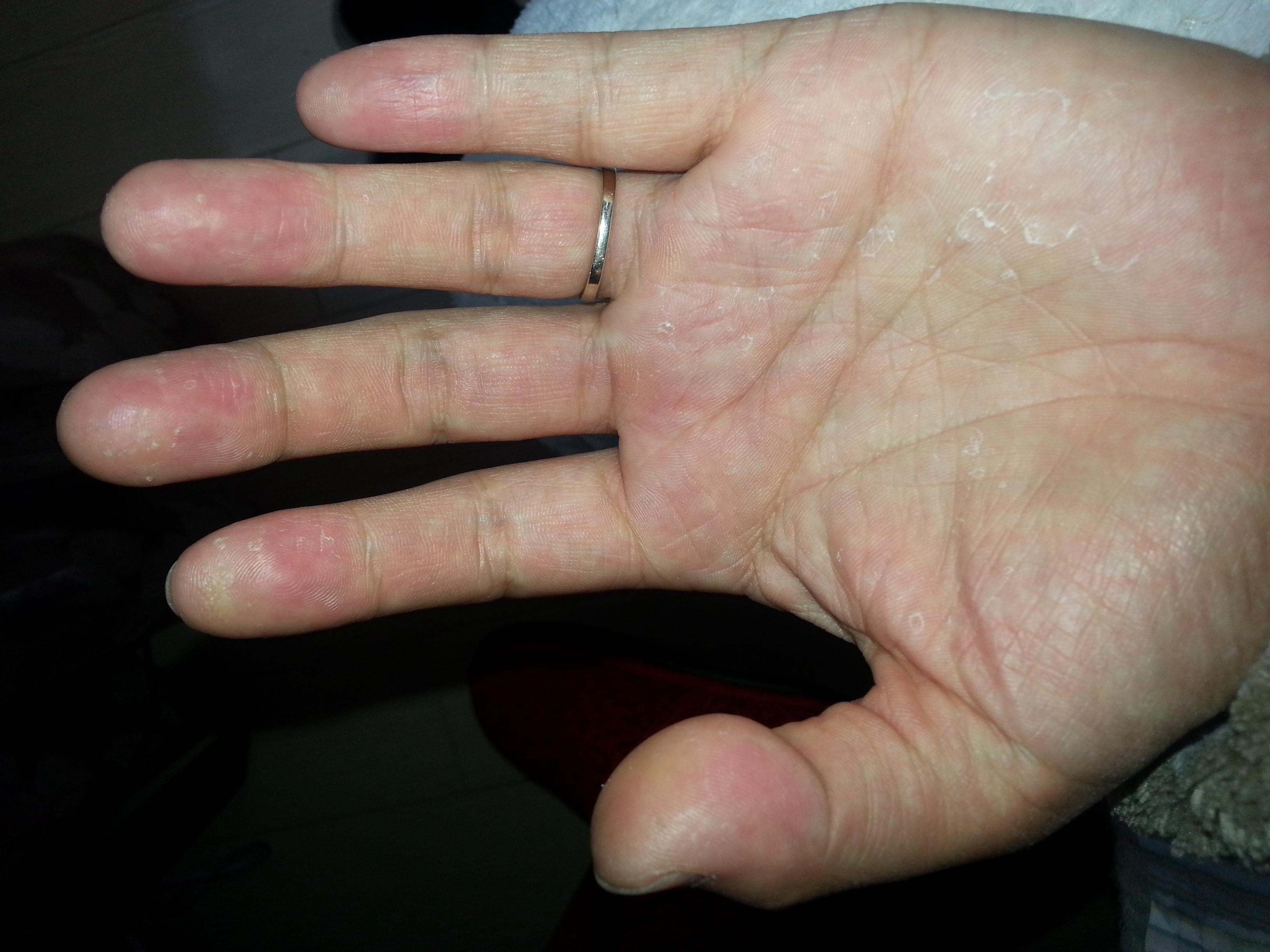 看看这个手怎么治疗啊