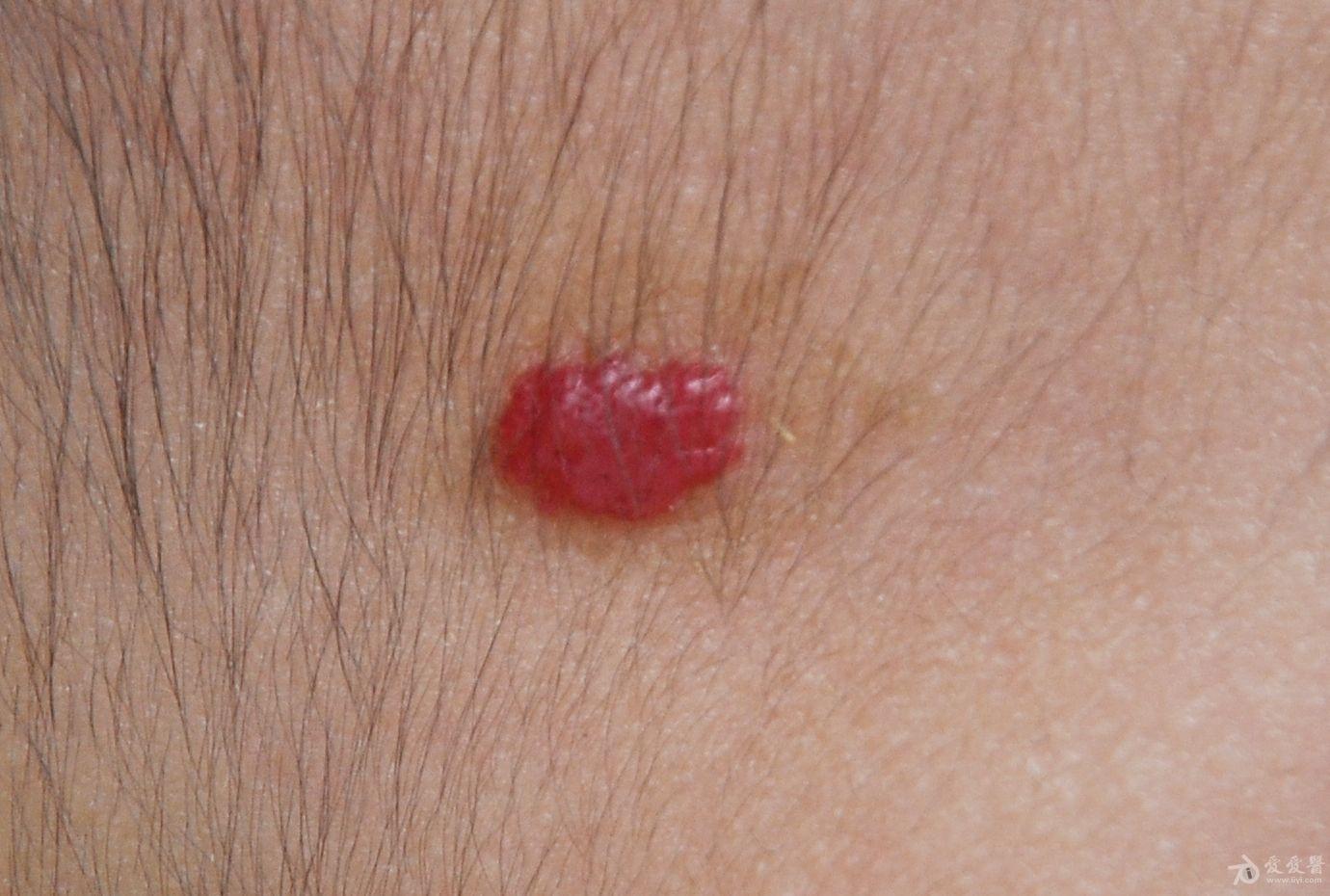 患儿是什么皮肤病