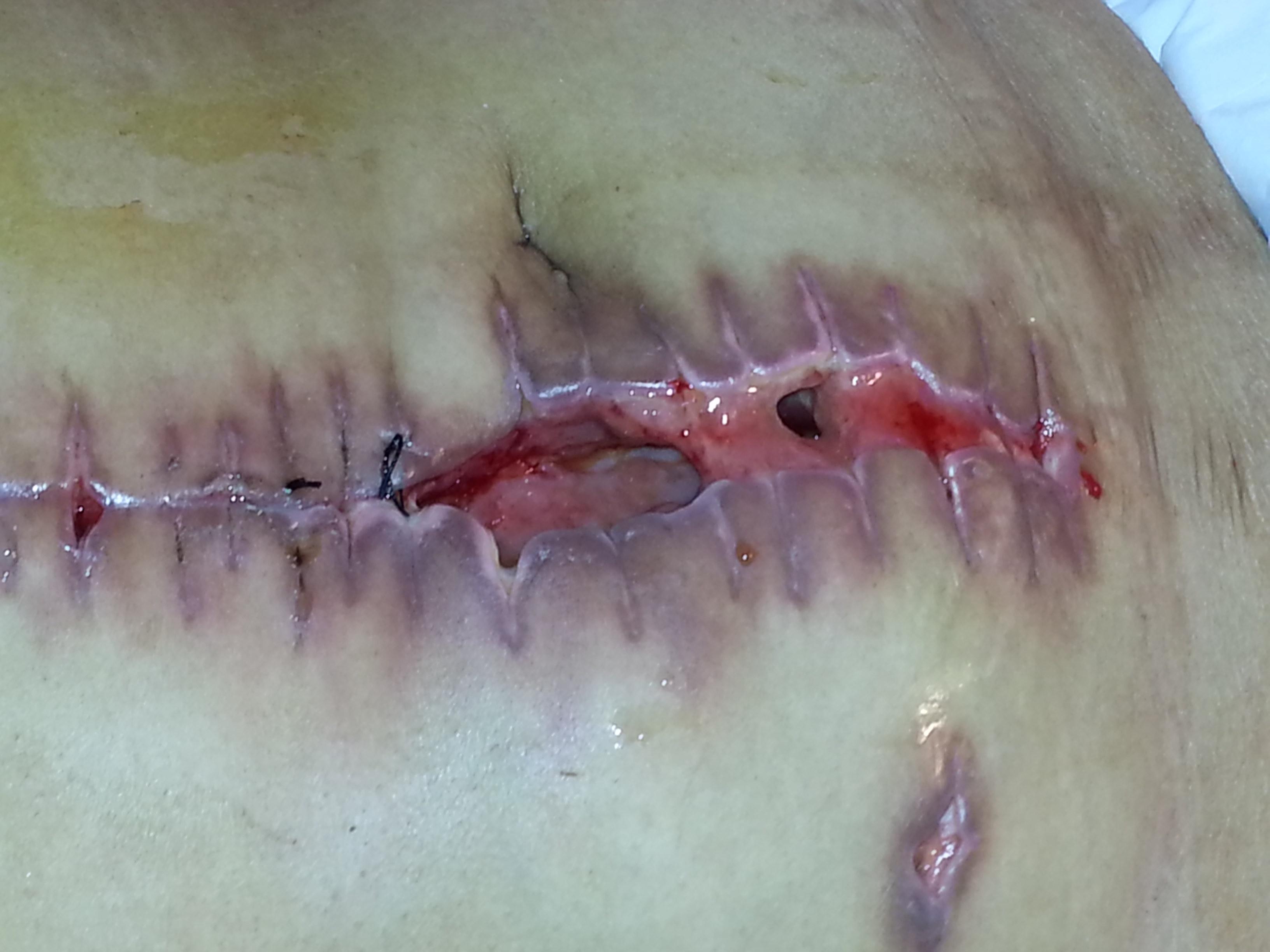 术后伤口脂肪液化图片图片