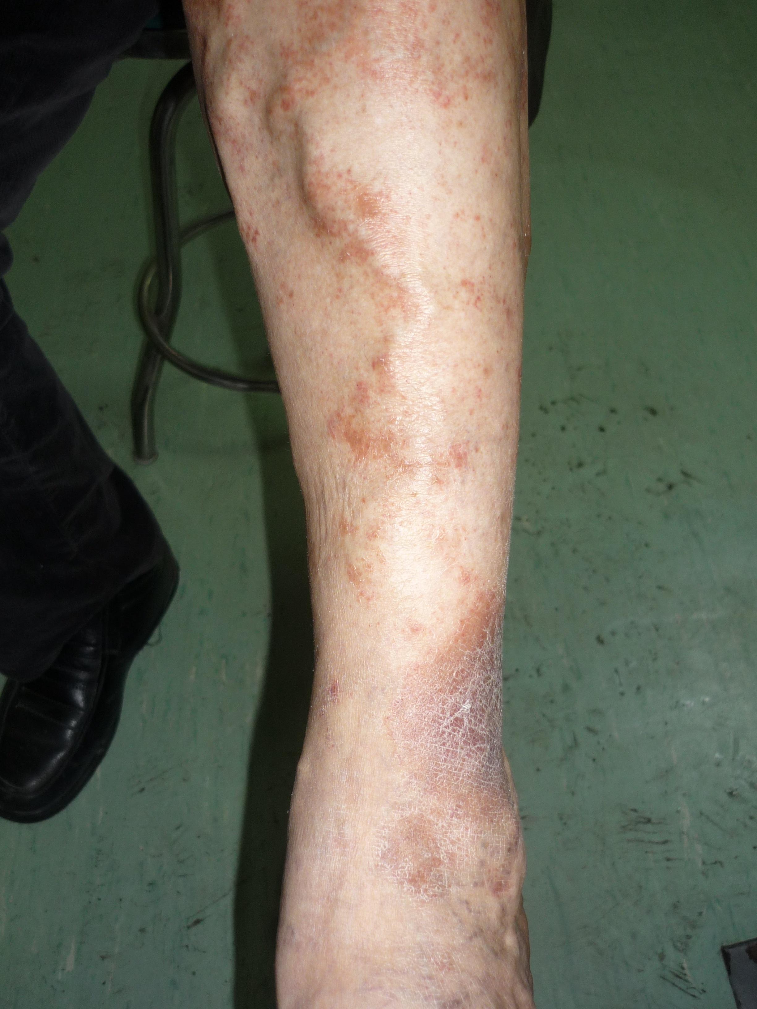 下肢结节性红斑图片图片