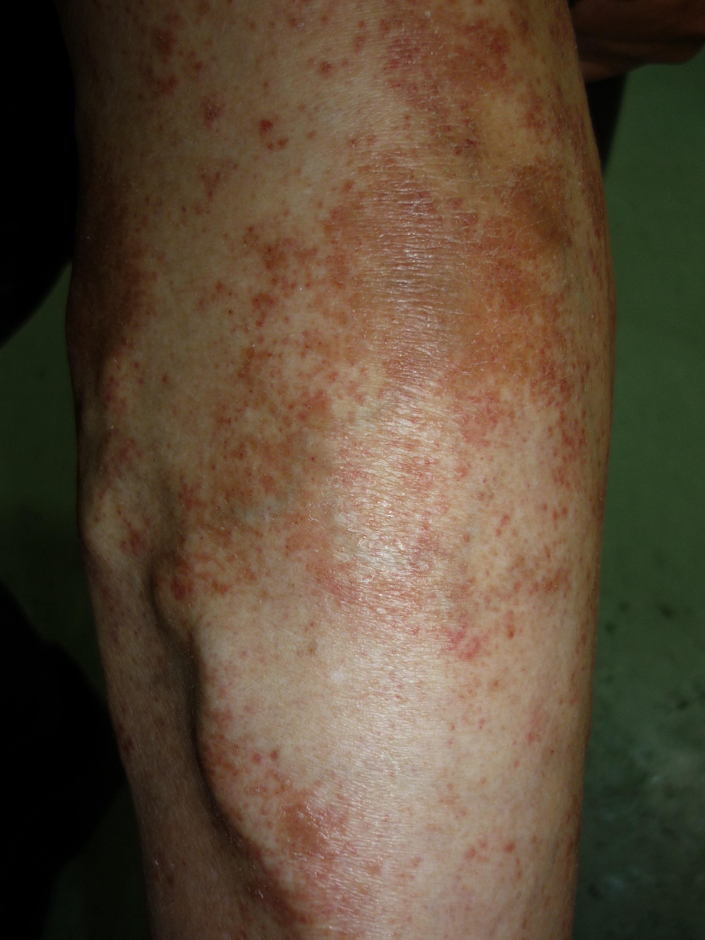 梅毒小腿症状图片图片