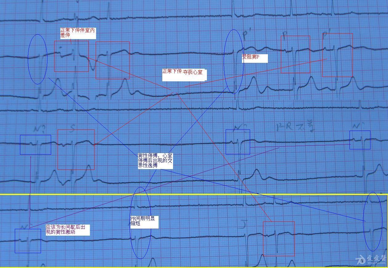 窦性心律,窦性停搏,窦性夺获,室内差传,交界性逸搏