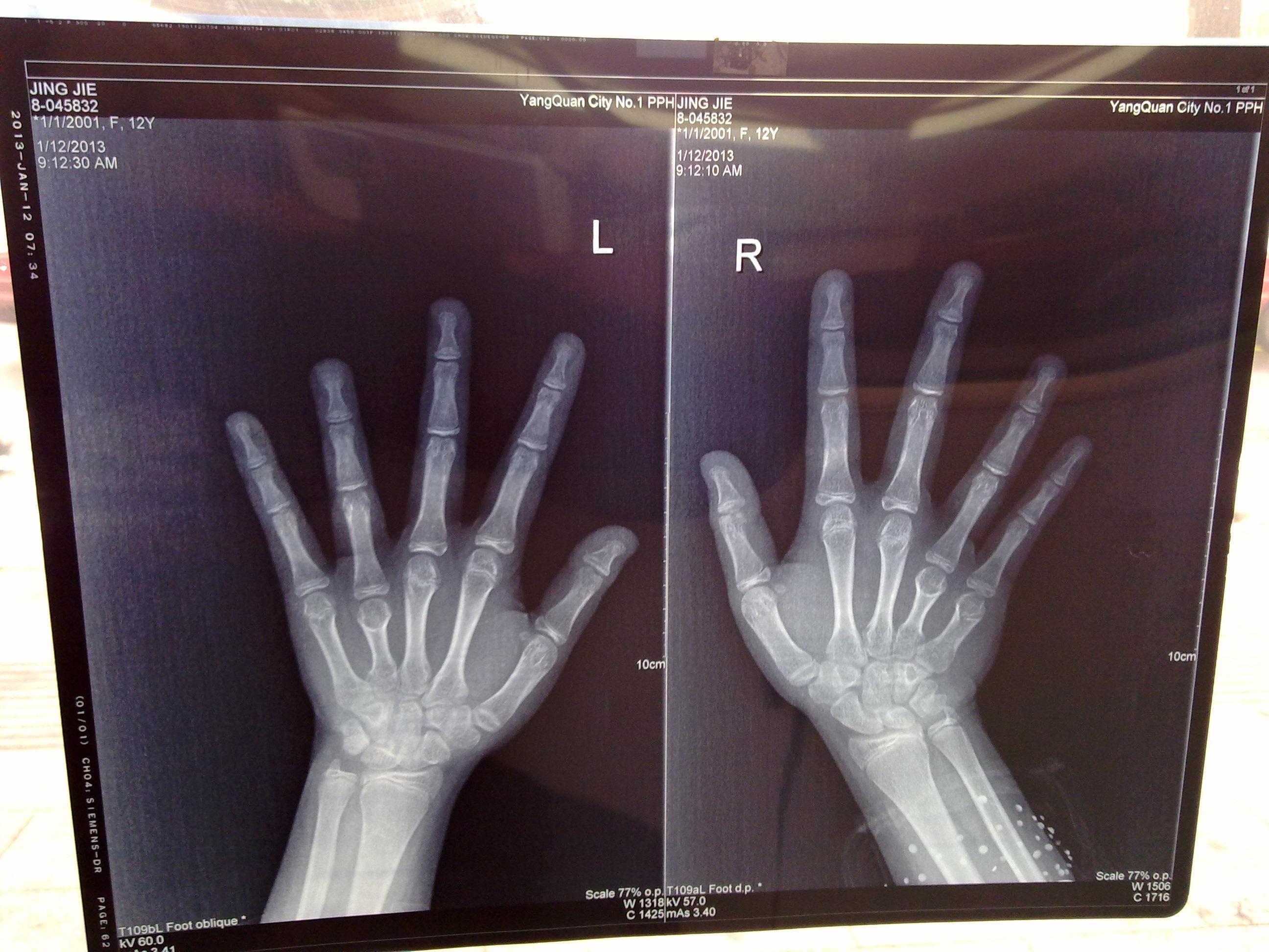 大家帮我看张手指的x光片