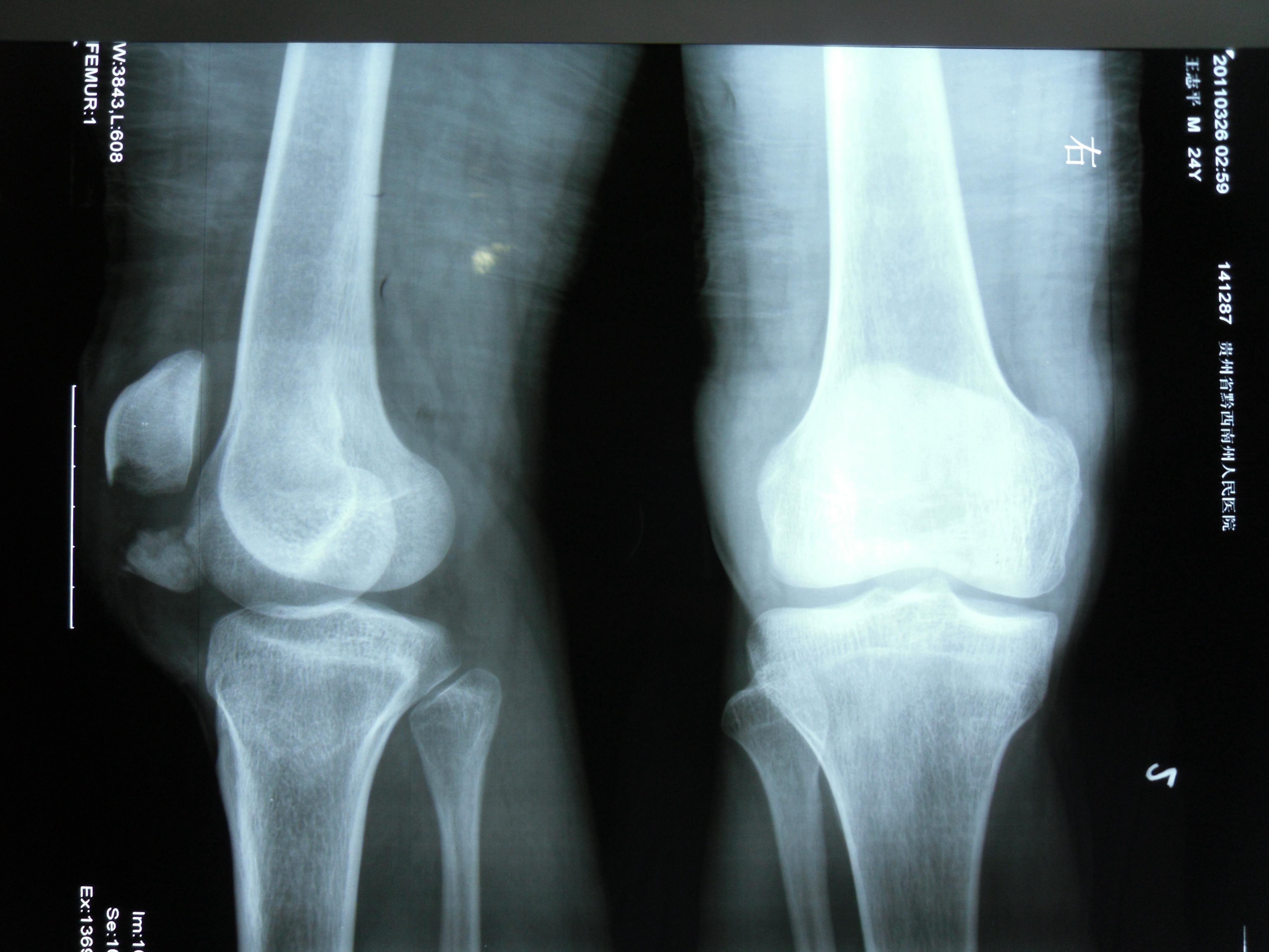 膝盖骨折片子真实图图片