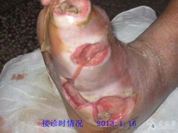 西医小子治疮疡