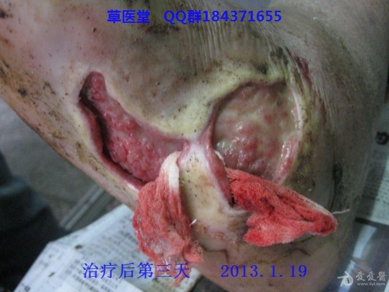 疮疡 www.iiyi.com