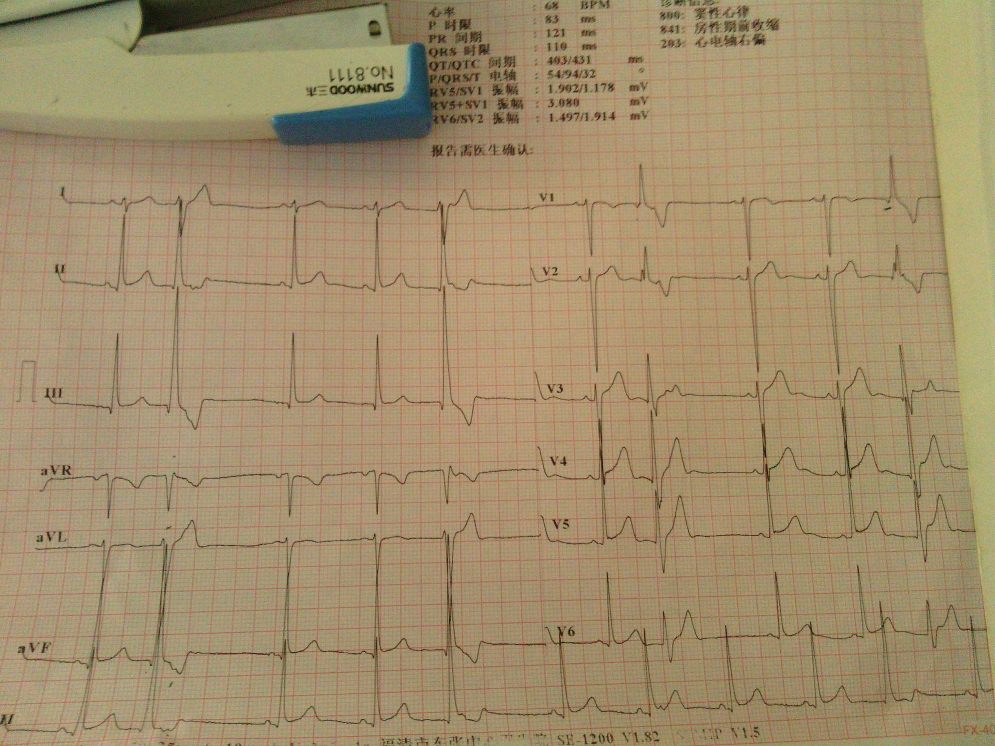 一个14岁小孩的心电图