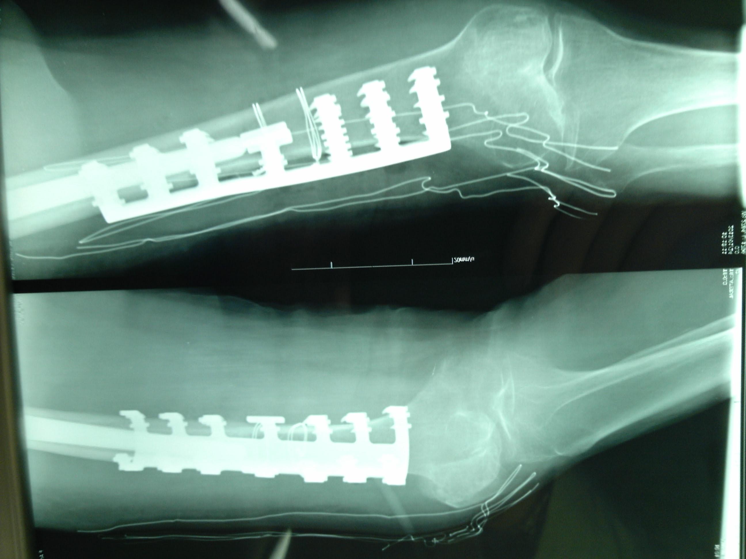 长柄人工股骨头置换术股骨下段骨折