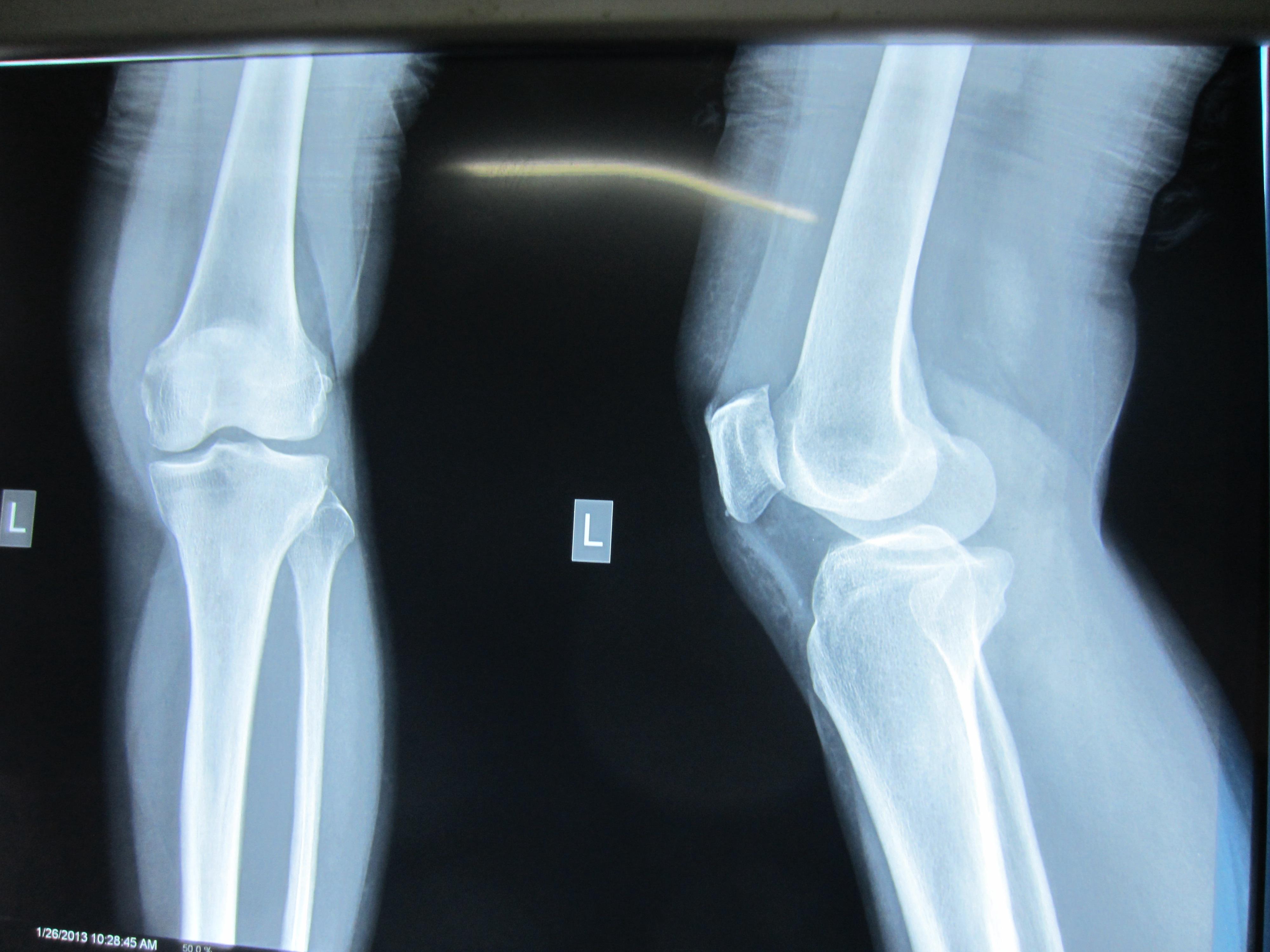 股骨髁骨折图片