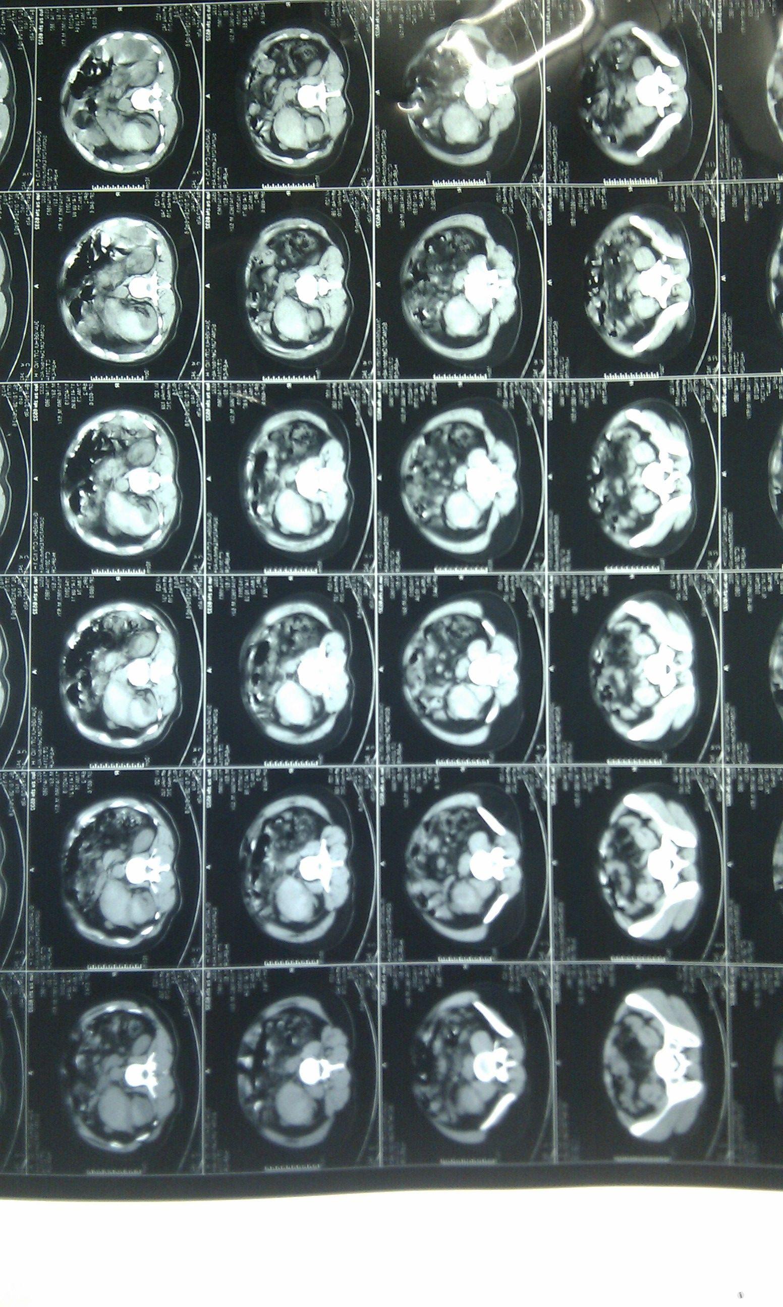 左肾包膜下血肿