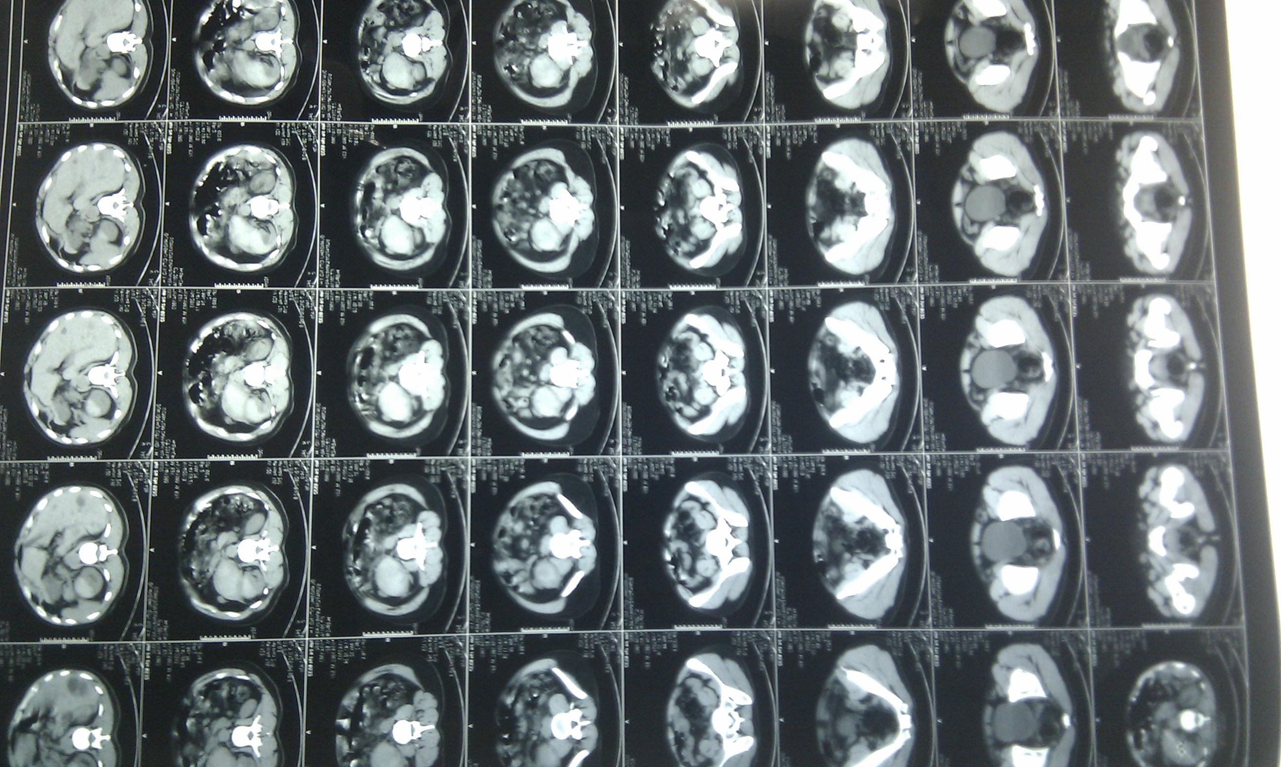 左肾包膜下血肿