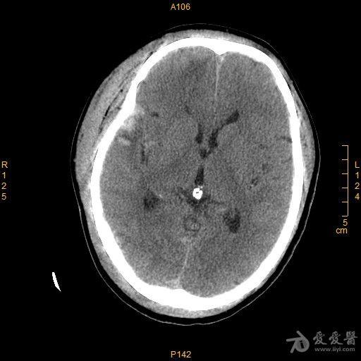 脑挫伤ct表现图片