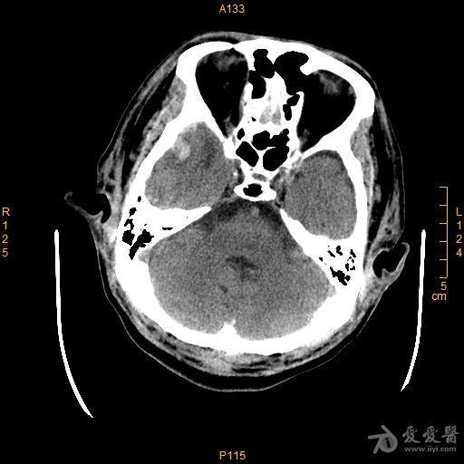 髓核破裂图片