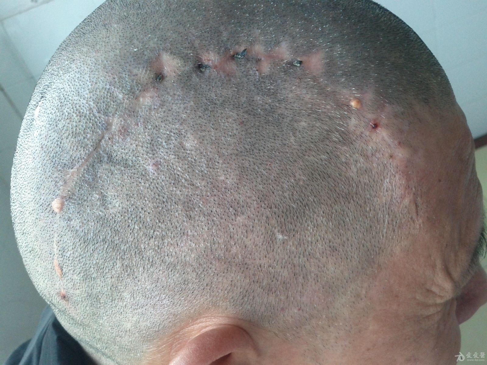 头皮手术疤痕图片