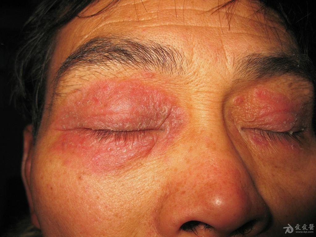 眼皮神经性皮炎症状图图片