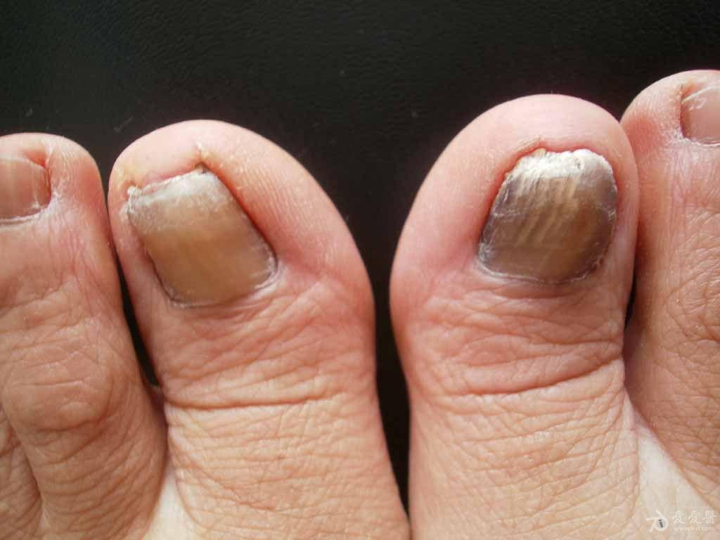 典型病例甲癣两例