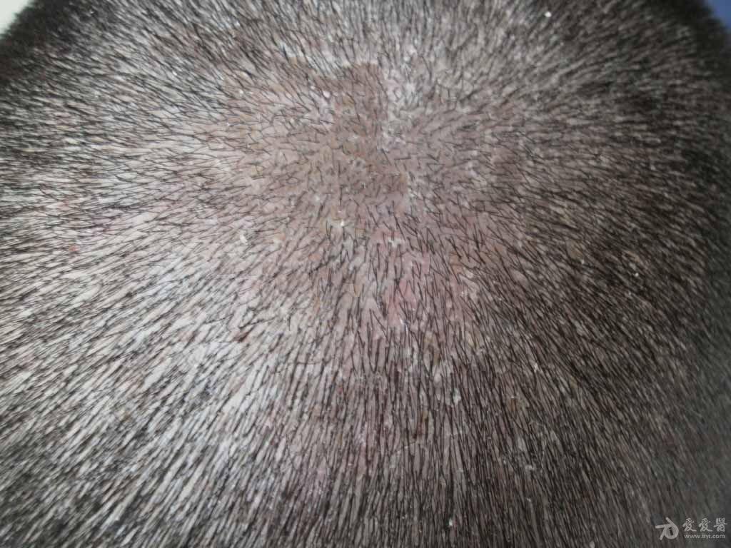 头脂溢性皮炎早期图片图片