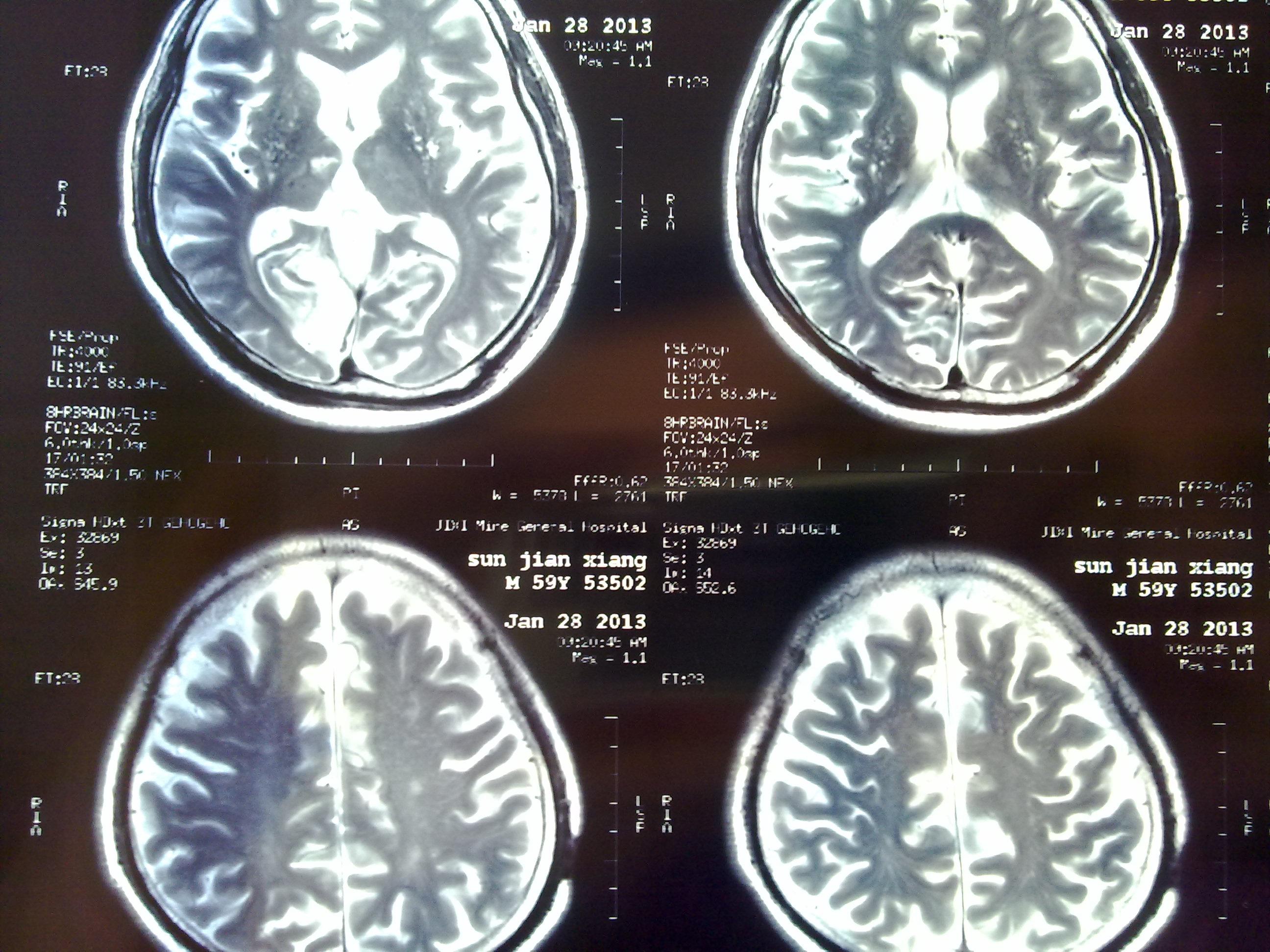 脑梗塞病人的头ct片,大家看看下一步的治疗