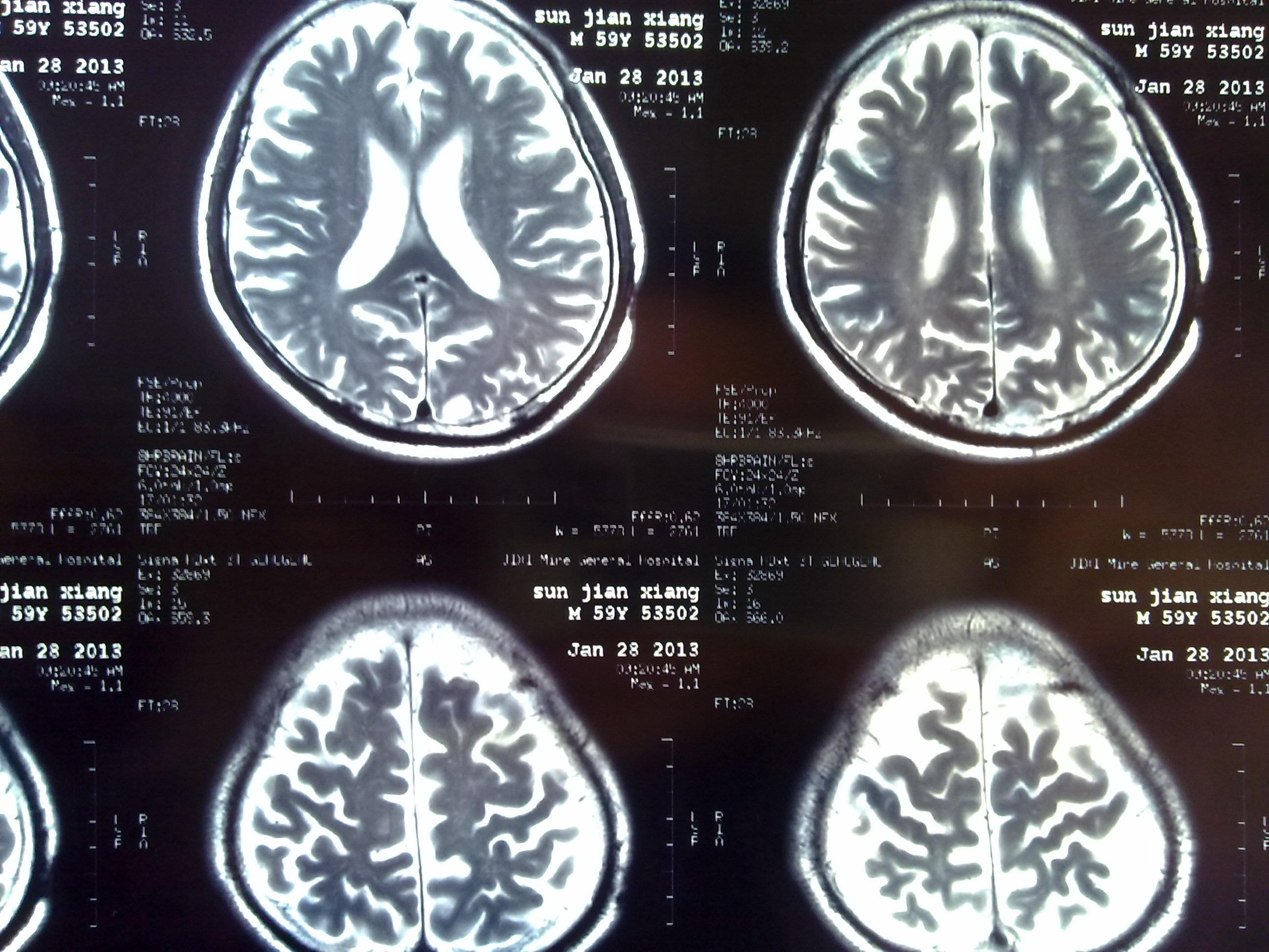 腦梗塞病人的頭ct片,大家看看下一步的治療