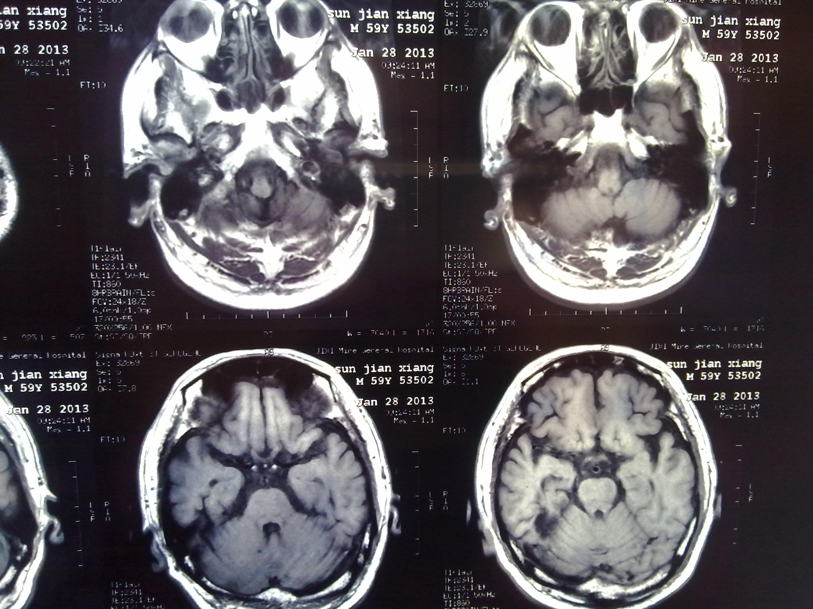 脑梗塞病人的头ct片,大家看看下一步的治疗