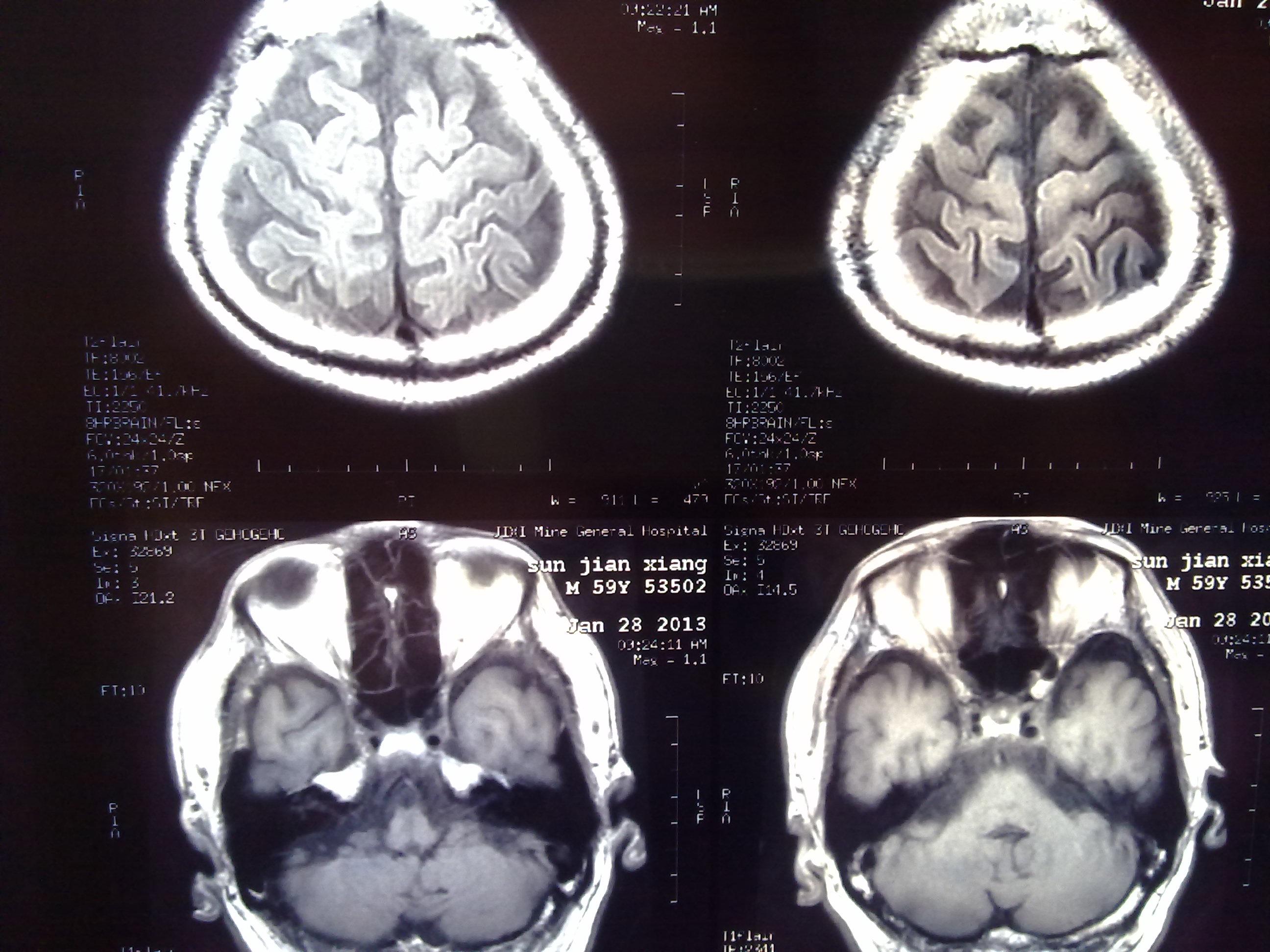 脑梗塞病人的头ct片,大家看看下一步的治疗