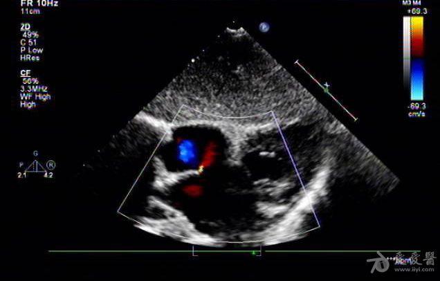 卵圆孔未闭或再开放——zengerya - 超声医学讨论版 - 爱爱医医学论坛