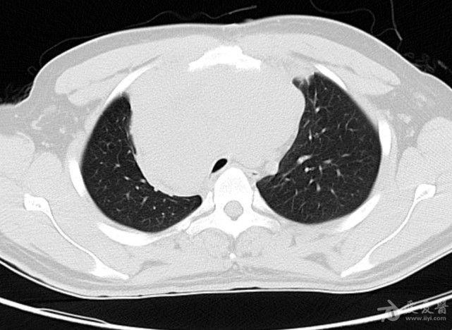 病例19恶性胸腺瘤