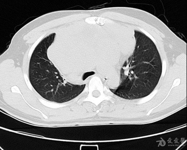 病例19恶性胸腺瘤