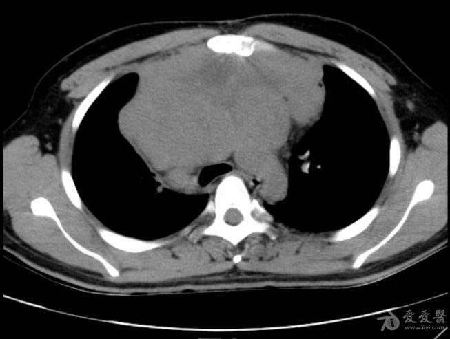 病例19恶性胸腺瘤