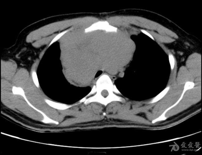 病例19恶性胸腺瘤