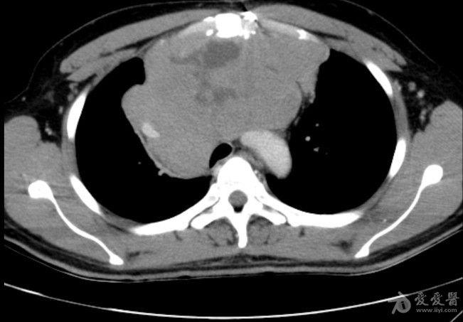 病例19恶性胸腺瘤