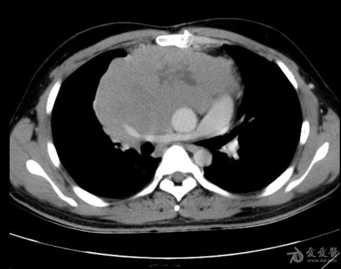 病例19恶性胸腺瘤