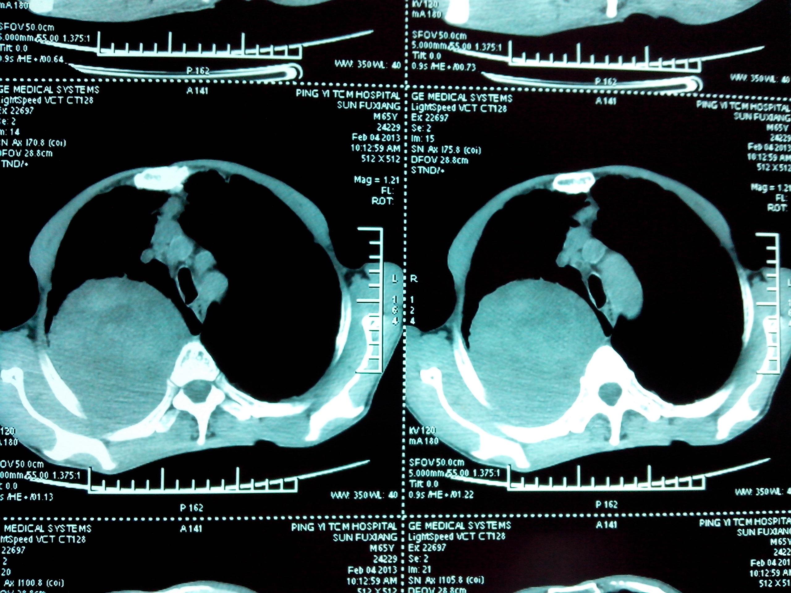 胸部ct閱片請各位老師發表意見