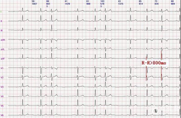 昂陳陳 -室性還是交界性並行心律-2-2.jpg